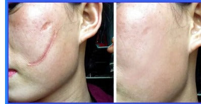 Sérum anti-cicatrice à l'acide hyaluronique pour l'élimination des cicatrices.